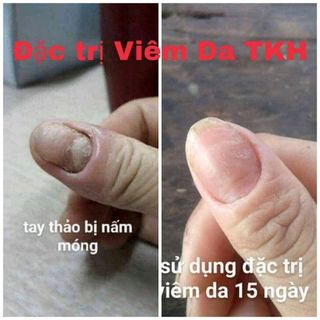 thuốc chữa hắc lào lang benviêm mãn tính