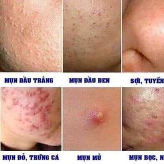 NẠ BẮC S WHITE TRỊ MỤNDƯỠNG DA TRẮNG HỒNGLIỀN SẸO RỖGIÁ 370K