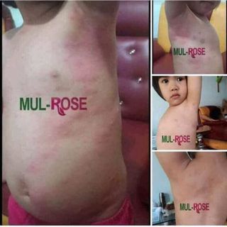 KEM ĐA NĂNG ĐẶC TRỊ VIEM DA CƠ ĐỊA MUL ROSE