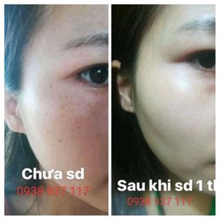 kem chuyên trị nám