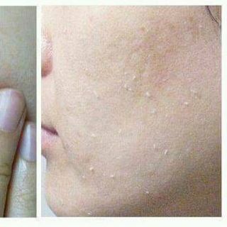 TẨY TẾ BÀO CHẾT CARENEL