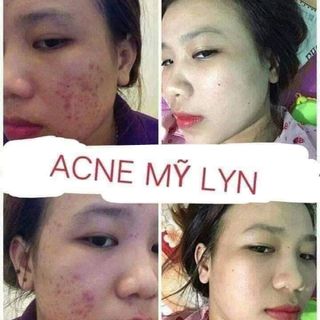 KEM MỤN ACNE