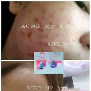 KEM MỤN ACNE