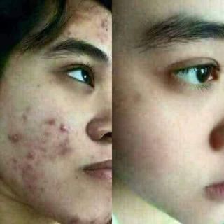 BỘ TRỊ MỤN NÁM TÀN NHANG DƯỠNG TRẮNG DA YANHEE
