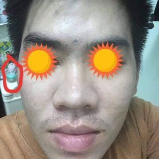 kem trị mụn thuốc bắc Amisa