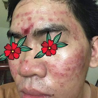 kem trị mụn thuốc bắc Amisa