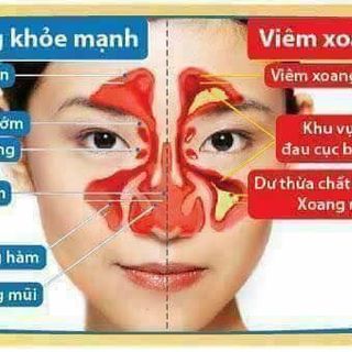 THUỐC TRỊ VIÊM XOANG THANH MỘC HƯƠNG