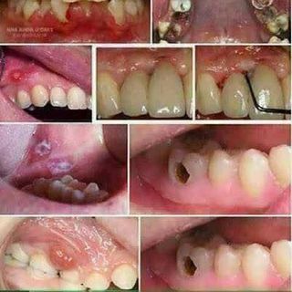 THUỐC TRỊ SÂU RĂNG THANH MỘC HƯƠNG