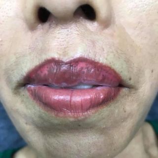 Dưỡng chuyên trị thâm loang