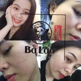 Trị mụn bà lão