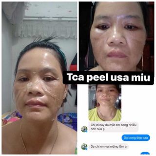LỘT MẶT - TCA PEEL USA 450k