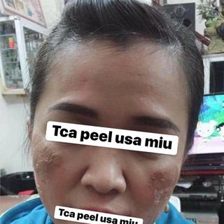 LỘT MẶT - TCA PEEL USA 450k