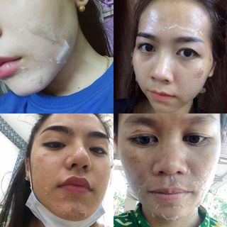 LỘT MẶT TRỊ THÂM NÁM - TCA PEEL USA