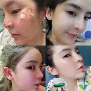 LỘT MẶT TRỊ THÂM NÁM - TCA PEEL USA