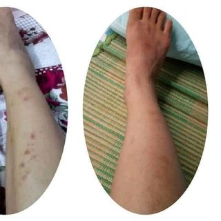 Trị thâm gia truyền Ngọc Thiên Hương