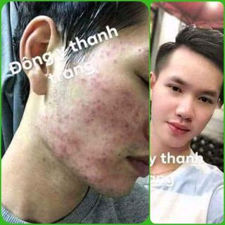 combo trị mụn