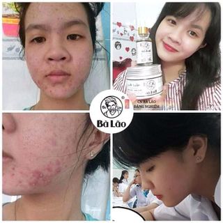 Nam Dược Trị mụn Bà Lão sỉ vốn 1tr500