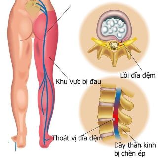 Khung Nắn Cột ng Diện Chẩn Từ Tính
