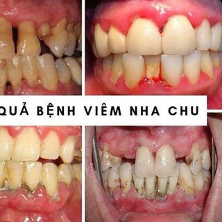 Giá sỉ bột trắng răng T White