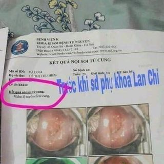 Kén Đặt Phụ Khoa Hồng Âm Tiêu Viêm Lan Chi