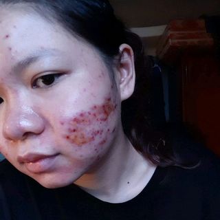 Thuốc bắc đông y tái tạo da SẮCVÂN