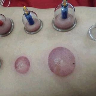 giác hơi không dùng lửa