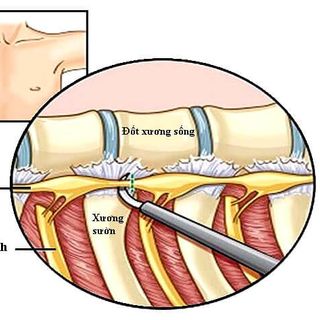 Phương pháp điều trị bệnh ra mồ hôi bẩm sinh