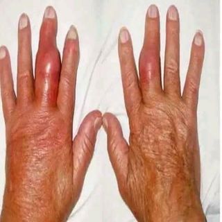 Cao thảo mộc trị đau khớp người già
