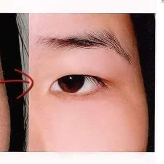 KEM TRỊ MỤN THỊT VÀ TRỊ THÂM QUẦNG MẮT