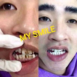 TRẮNG RĂNG THAN HOẠT TÍNH MY SMILE