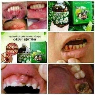 THUỐC TRỊ RĂNG MIỆNG giá sỉ