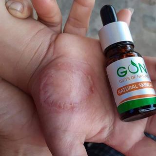 SERUM GON - DƯỢC MỸ PHẨM THIÊN NHIÊN
