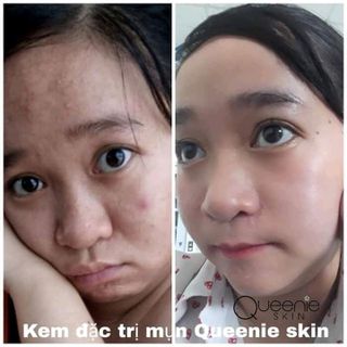 kem trị mụn queenie