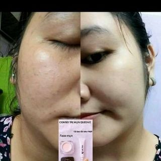 kem trị mụn queenie