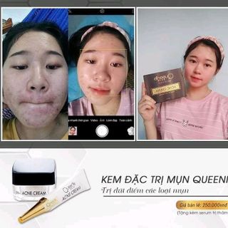 kem trị mụn queenie