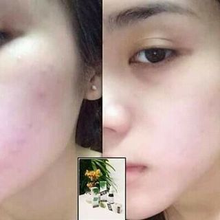 Trị mụnthâmnám BẠCH ĐAN DƯỢC