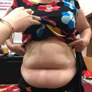 Đai nịt siêu giảm mỡ bụng hy lạp