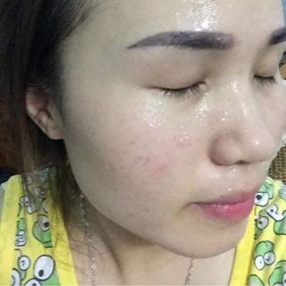 Thuốc Bắc tái tạo da thuốc trị mụn đông y giá sỉ sản xuất