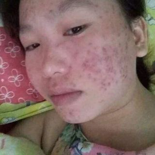 Thuốc Bắc tái tạo da thuốc trị mụn đông y giá sỉ sản xuất
