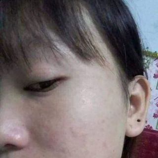 Thuốc Bắc tái tạo da thuốc trị mụn đông y giá sỉ sản xuất