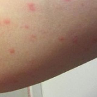 Thuốc nam trị viêm da cơ địa