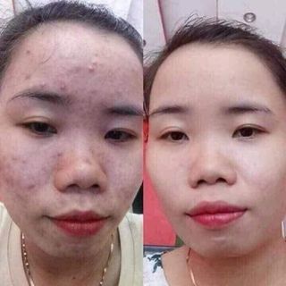 SERUM GON - DƯỢC MỸ PHẨM TỪ THIÊN NHIÊN