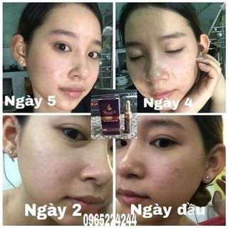 Kem trị mụn