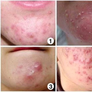 Thuốc Trị Mụn