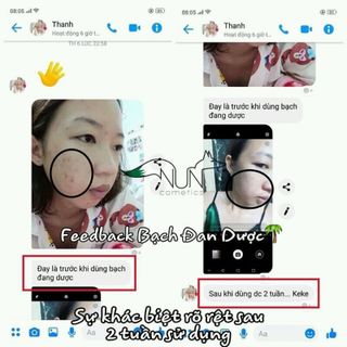 Serum dưỡng da trị ThâmMụnSẹoNám cao cấp BẠCH ĐAB DƯỢC