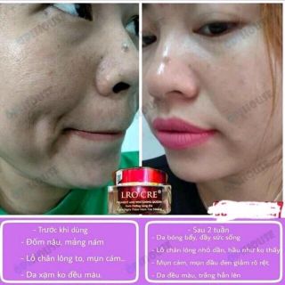 Kem dưỡng ban đêm chuyên trị Mụn Nám Tàn Nhang