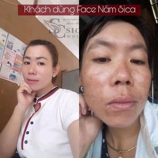 Kem ĐẶC TRỊ NÁM CAO CẤP