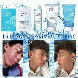 bộ sản phẩm trị mụn PURE SKIN