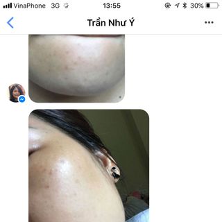 Trị nám