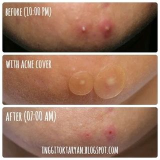 Miếng dán trị mụn 3M Nexcare